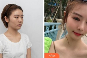 溫州東華醫(yī)院醫(yī)療美容科萬志華整形價格表附眼部綜合案例展示