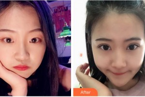 溫州星范醫(yī)學美容門診部應天詳整形價格表附切開雙眼皮案例展示