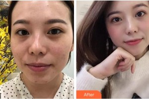 溫州芙萊拉醫(yī)療美容醫(yī)院胡彬整形價格表附激光去眼袋案例展示