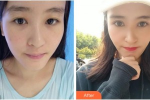 溫州芙萊拉醫(yī)療美容醫(yī)院但漢乾整形價格表附切開雙眼皮案例展示