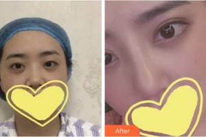 溫州藝星醫(yī)學美容醫(yī)院柴軍整形價格表附眼部綜合案例展示