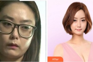 溫州藝星醫(yī)學美容醫(yī)院成浩整形價格表附內切祛眼袋案例展示