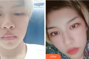 溫州佑康和平整形醫(yī)院陳炳偉整形價格表附切開雙眼皮案例展示