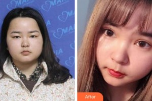 溫州佑康和平整形醫(yī)院蔡東亮整形價格表附切開雙眼皮案例展示