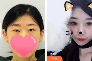 溫州藝星醫(yī)學美容醫(yī)院黃樂整形價格表附切開雙眼皮案例展示