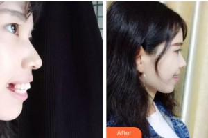 溫州牙科醫(yī)院鄭翔整形價格表附隱形托槽矯正案例展示