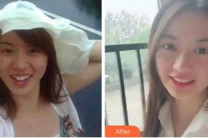 溫州王曉峰口腔醫(yī)院孫相宇整形價格表附金屬托槽矯正案例展示