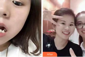 溫州市中西醫(yī)結(jié)合醫(yī)院醫(yī)學美容中心柯友輝整形價格表附牙齒陶瓷矯正案例展示