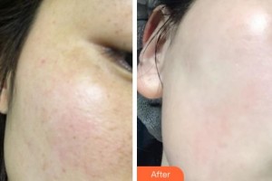 溫州市人民醫(yī)院整形外科周建敏整形價格表附光子嫩膚案例展示