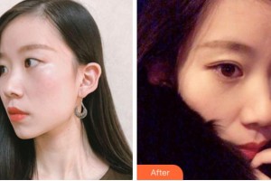 溫州伯思立醫(yī)院醫(yī)療美容科李茂群整形價格表附眼部綜合案例展示