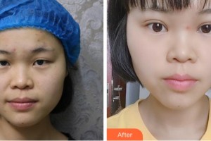 溫州伯思立醫(yī)院醫(yī)療美容科周薇整形價格表附切開雙眼皮案例展示