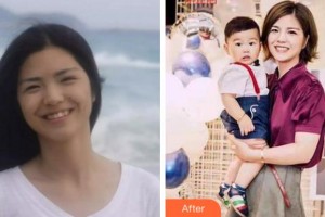 溫州醫(yī)科大學附屬口腔學院麻健豐整形價格表附牙齒隱形矯正案例展示