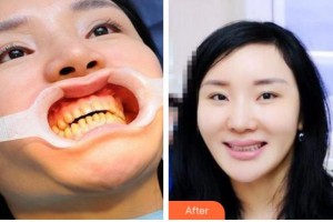 溫州醫(yī)科大學附屬口腔學院潘乙懷整形價格表附美白貼片案例展示