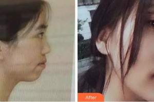 溫州醫(yī)科大學附屬口腔學院胡榮黨整形價格表附金屬托槽矯正案例展示