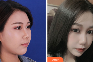 深圳美客華美醫(yī)療美容門診部整形價(jià)格表附雙下巴吸脂案例展示