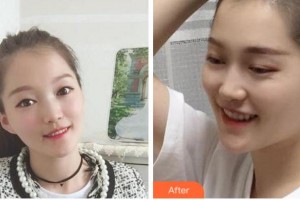 溫州醫(yī)科大學附屬口腔學院鄧輝整形價格表附金屬托槽矯正案例展示