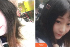 溫州醫(yī)科大學附屬口腔學院金向青整形價格表附金屬托槽矯正案例展示