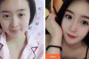 深圳易容顏醫(yī)療美容門診部魏曉峰整形價(jià)格表附仿生翹睫雙眼皮案例展示