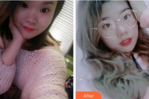 溫州醫(yī)科大學附屬口腔學院黃盛斌整形價格表附牙齒隱形矯正案例展示