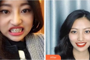 溫州醫(yī)科大學附屬口腔學院劉傳通整形價格表附牙齒陶瓷矯正案例展示