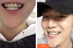 深圳易容顏醫(yī)療美容門診部王航整形價(jià)格表附隱適美隱形矯正案例展示