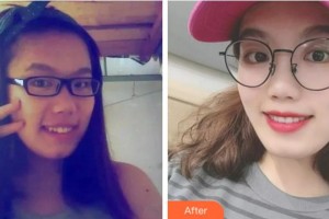 溫州醫(yī)科大學附屬口腔學院鄭敏玲整形價格表附隱形托槽矯正案例展示