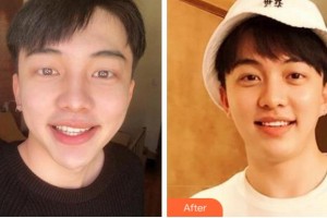 溫州醫(yī)科大學附屬口腔學院王劍鋒整形價格表附美白貼片案例展示