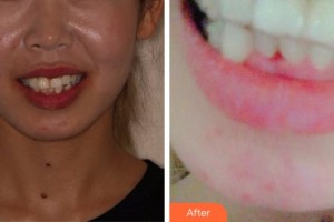 溫州醫(yī)科大學附屬口腔學院蔡志斌整形價格表附牙齒隱形矯正案例展示