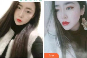 溫州醫(yī)科大學附屬口腔學院聶鑫整形價格表附金屬托槽矯正案例展示