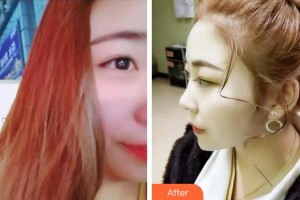 溫州醫(yī)科大學附屬口腔學院王惠寧整形價格表附超聲波潔牙案例展示