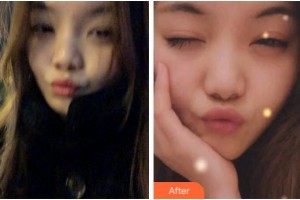 溫州醫(yī)科大學附屬口腔學院何奎芳整形價格表附牙齒隱形矯正案例展示