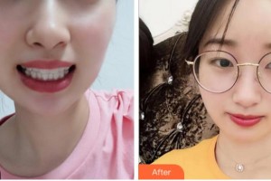 溫州醫(yī)科大學附屬口腔學院倪振宇整形價格表附牙齒隱形矯正案例展示