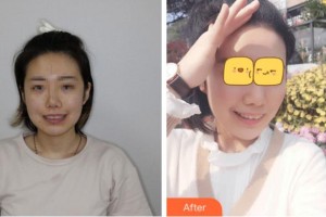 溫州醫(yī)科大學附屬口腔學院李鋒整形價格表附口腔矯正案例展示