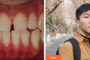 溫州醫(yī)科大學附屬口腔學院曹真勝整形價格表附金屬托槽矯正案例展示