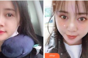 溫州醫(yī)科大學附屬口腔學院王思錢整形價格表附自鎖托槽矯正案例展示