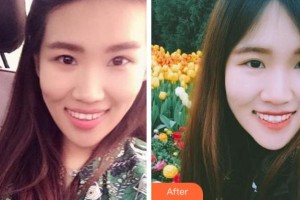 溫州王曉峰口腔醫(yī)院陳北云整形價格表附牙齒隱形矯正案例展示