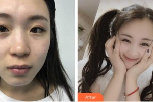 溫州明樂眼科醫(yī)院樸正勛整形價格表附眼部綜合案例展示