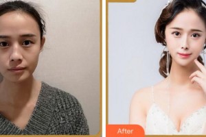 溫州醫(yī)科大學附屬眼視光醫(yī)院吳文燦整形價格表附眼部綜合案例展示