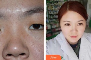 溫州醫(yī)科大學附屬眼視光醫(yī)院傅映暉整形價格表附眼部綜合案例展示