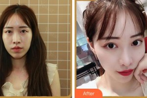 溫州醫(yī)科大學附屬眼視光醫(yī)院葉宇峰整形價格表附眼部綜合案例展示