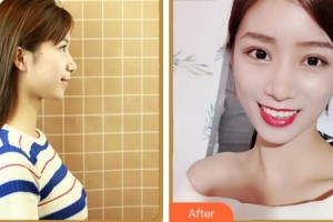 溫州醫(yī)科大學附屬眼視光醫(yī)院溫淑梅整形價格表附眼鼻多項案例展示