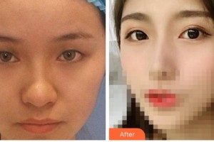 溫州醫(yī)科大學附屬眼視光醫(yī)院李軍花整形價格表附切開雙眼皮案例展示