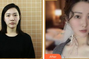 溫州醫(yī)科大學附屬眼視光醫(yī)院鄭斌整形價格表附眼部綜合案例展示