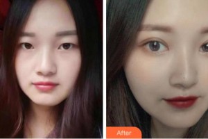 溫州醫(yī)科大學附屬眼視光醫(yī)院侯立杰整形價格表附切開雙眼皮案例展示