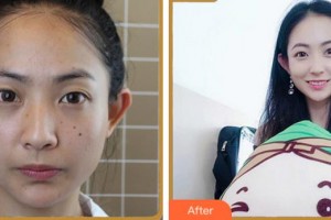 溫州醫(yī)科大學附屬眼視光醫(yī)院張赟整形價格表附眼部綜合案例展示