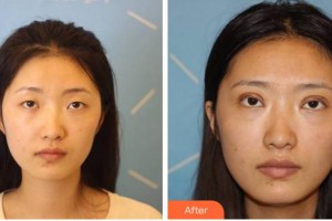 溫州醫(yī)科大學附屬眼視光醫(yī)院戴琦整形價格表附切開雙眼皮案例展示