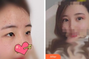 溫州醫(yī)科大學附屬眼視光醫(yī)院陳亦棋整形價格表附切開雙眼皮案例展示