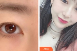 溫州醫(yī)科大學附屬眼視光醫(yī)院聶莉整形價格表附眼部綜合案例展示