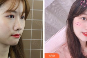 溫州醫(yī)科大學附屬眼視光醫(yī)院常平駿整形價格表附眼部整形案例展示