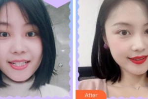 溫州拜博口腔醫(yī)院唐甸飛整形價格表附金屬托槽矯正案例展示